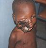 BENIN: Young faces eaten away ...